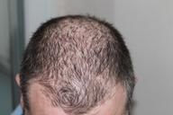 hair-man-hair-loss-head-248050.jpg